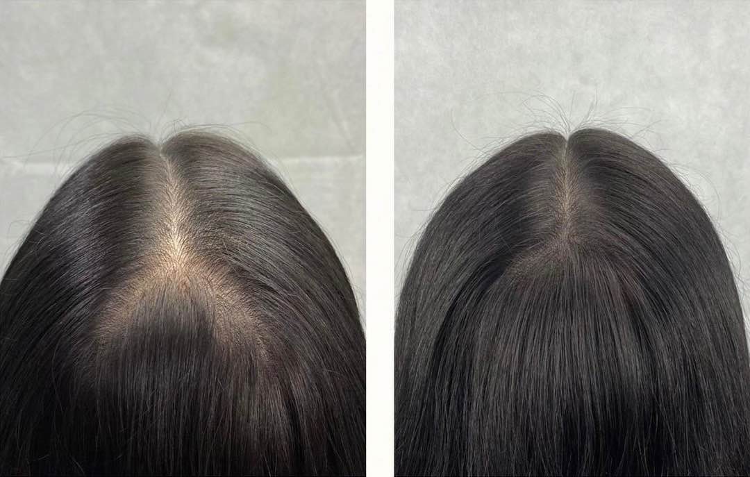 Scalp